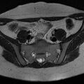 Bicornuate uterus (Radiopaedia 72135-82643 Axial T2 2).jpg