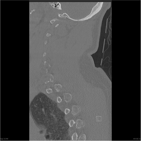 File:Bilateral cervical ribs (Radiopaedia 25868-26017 Sagittal bone window 55).jpg