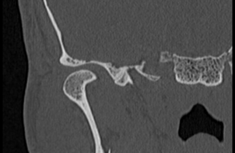 File:Bilateral cholesteatoma (Radiopaedia 54898-61172 Coronal bone window 1).jpg
