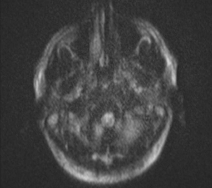 File:Bilateral cholesteatoma (Radiopaedia 54898-61173 Axial DWI 1).jpg
