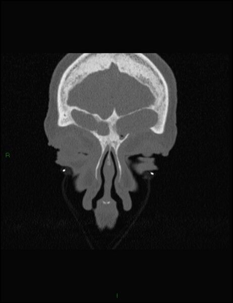 File:Bilateral frontal mucoceles (Radiopaedia 82352-96454 Coronal 62).jpg