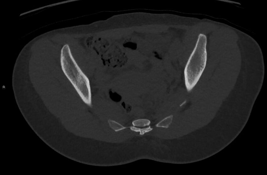 Bilateral mature cystic ovarian teratoma (Radiopaedia 88821-105592 Axial bone window 14).jpg