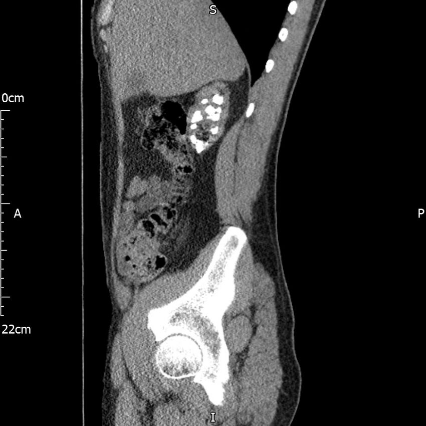 Bilateral medullary nephrocalcinosis with ureteric calculi (Radiopaedia 71269-81569 C 84).jpg