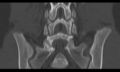 Bilateral pars defect (Radiopaedia 26691-26846 Coronal bone window 31).jpg