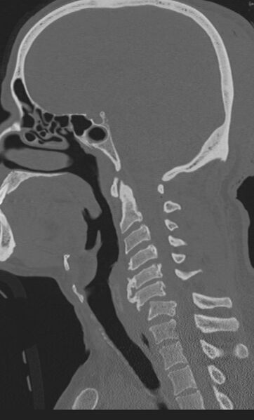 File:Bilateral perched facet joint (Radiopaedia 63149-71669 Sagittal bone window 32).jpg