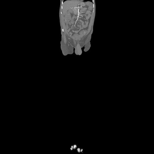File:Bilateral superficial femoral arterial occlusion (Radiopaedia 25682-25857 Coronal MIP 8).jpg