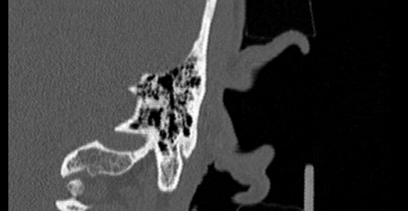File:Bilateral temporal bone fractures (Radiopaedia 29482-29970 B 85).jpg