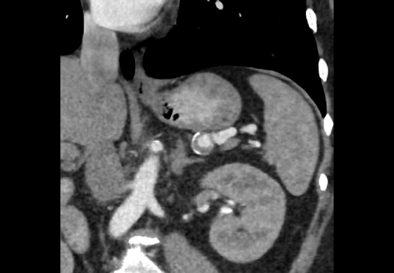 File:Bilateral urolithiasis with incidentally detected splenic artery aneurysm and left inferior vena cava (Radiopaedia 44467-48127 Ob. Cor. C+ Art. 13).jpg