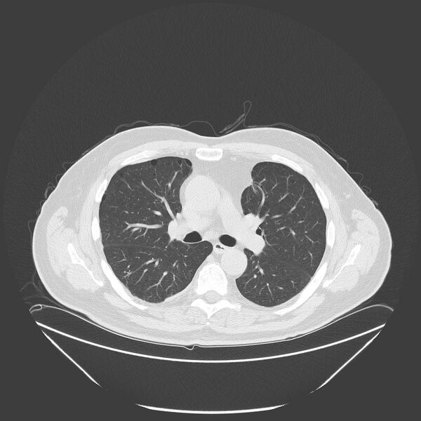 File:Birt-Hogg-Dubé syndrome (Radiopaedia 52578-58491 Axial lung window 26).jpg