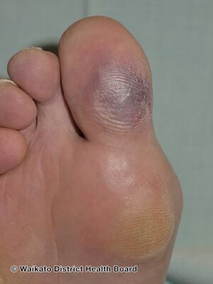 Blue toe syndrome- ischaemia (DermNet NZ blue-toe-syndrome-002).jpg