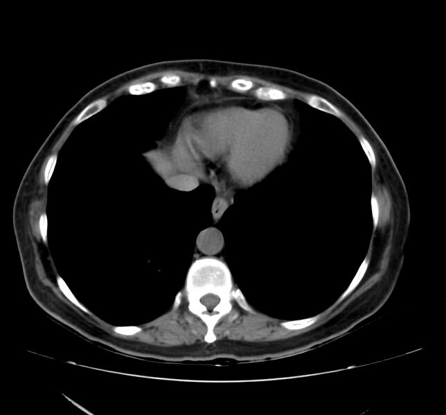 File:Bosniak renal cyst - type IV (Radiopaedia 22929-22953 Axial non-contrast 2).jpg