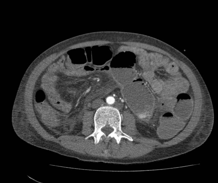 File:Bowel lymphoma complicated by bleeding after therapy (Radiopaedia 55601-62110 B 42).jpg