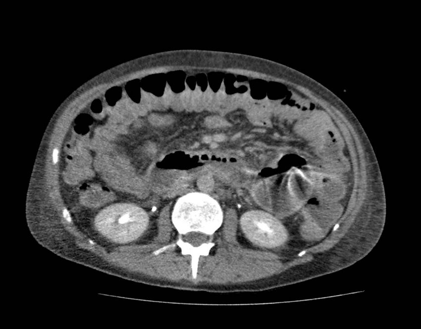 Bowel lymphoma complicated by bleeding after therapy (Radiopaedia 55601-62110 C 40).jpg