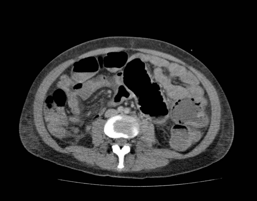 Bowel lymphoma complicated by bleeding after therapy (Radiopaedia 55601-62110 C 48).jpg