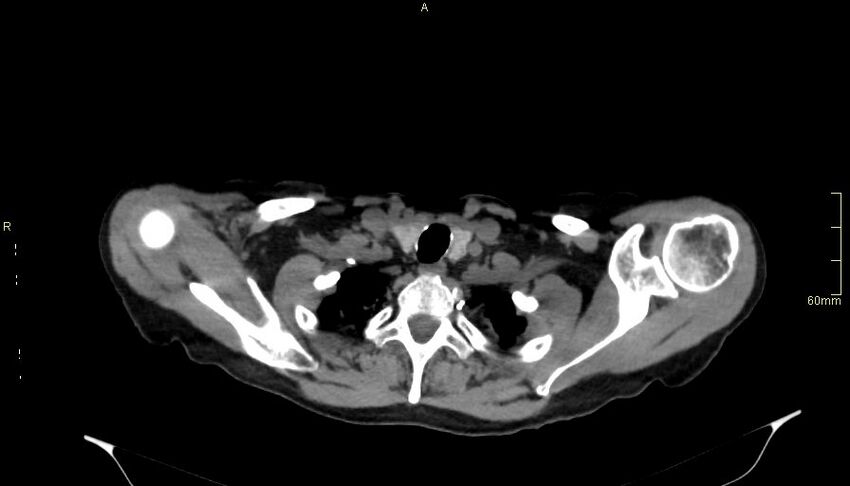 Brachial artery foreign body (Radiopaedia 54583-60820 Axial non-contrast 10).jpg