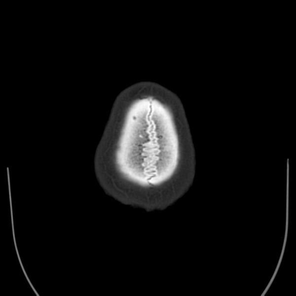 File:Brain Pantopaque remnants (Radiopaedia 78403-91048 Axial bone window 66).jpg
