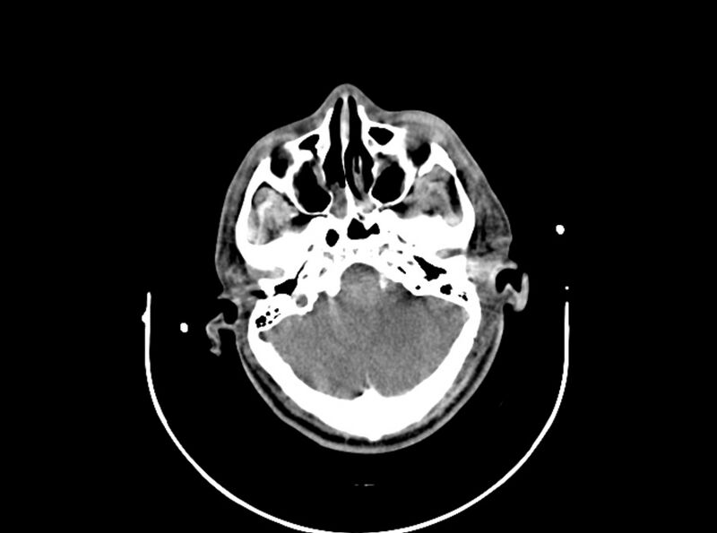 File:Brain injury by firearm projectile (Radiopaedia 82068-96087 B 61).jpg