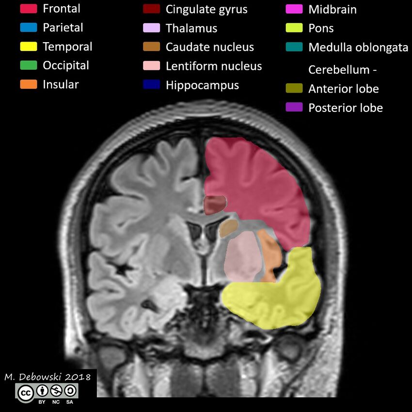 Brain lobes - annotated MRI (Radiopaedia 61691-69700 Coronal 31).JPG