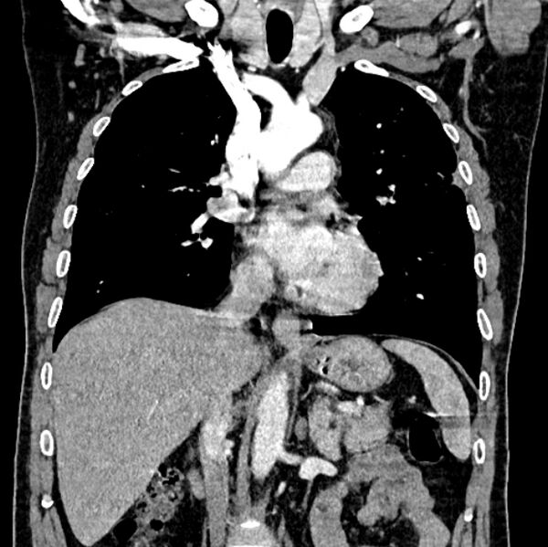 File:Brain metastases - lung cancer primary (Radiopaedia 75060-86116 C+ arterial phase 31).jpg
