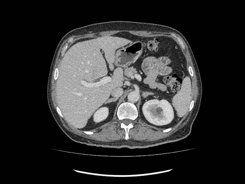 Brain metastases from renal cell carcinoma (Radiopaedia 42222-45328 B 35).jpg