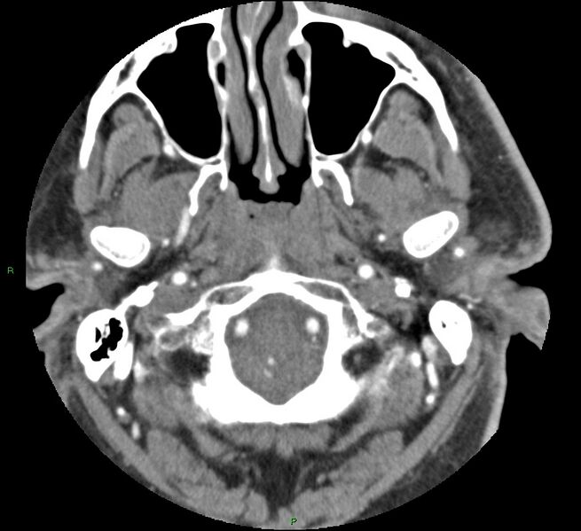 File:Brainstem hemorrhage (Radiopaedia 58794-66028 D 22).jpg