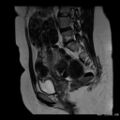 Broad ligament fibroid (Radiopaedia 49135-54241 Sagittal T2 16).jpg