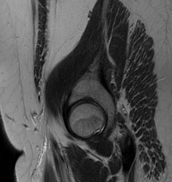 File:Broad ligament leiomyoma (Radiopaedia 81634-95516 Sagittal T2 1).jpg