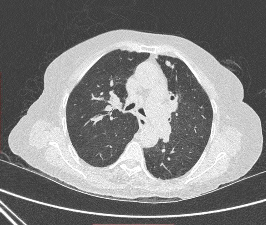 Bronchiectasis (Radiopaedia 72693-83293 Axial lung window 51).jpg