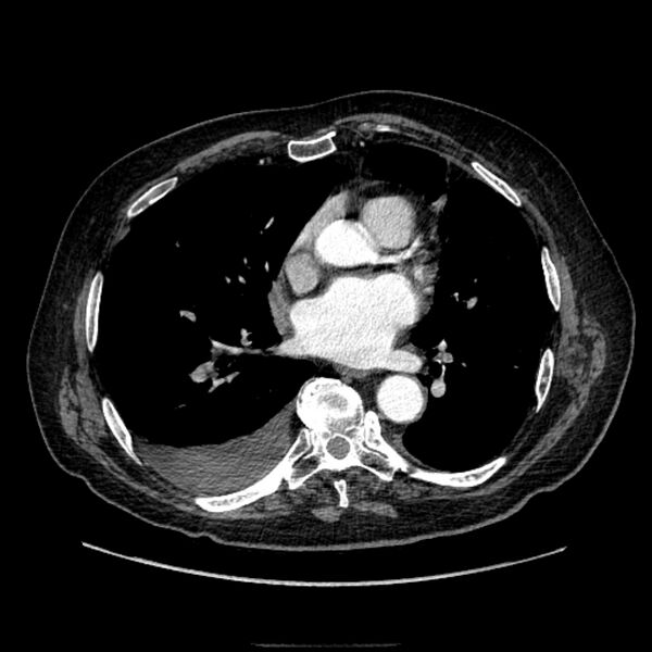 File:Bronchogenic adenocarcinoma and pulmonary embolism (Radiopaedia 9097-9806 D 36).jpg