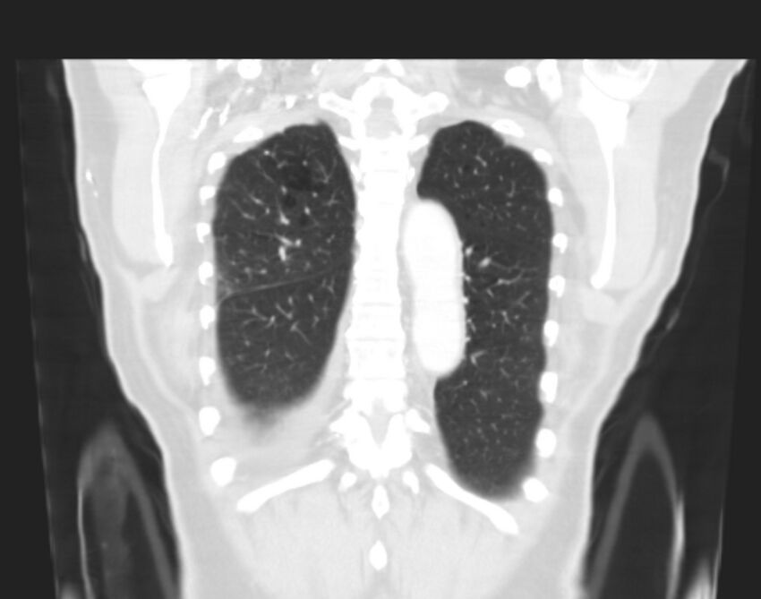 Bronchogenic carcinoma with lymphangitic spread (Radiopaedia 29002-29357 Coronal lung window 59).jpg