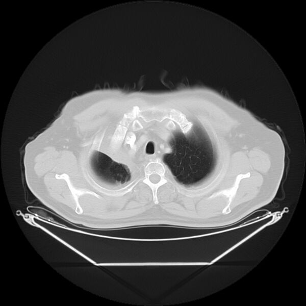 File:Bronchogenic carcinoma with upper lobe collapse (Radiopaedia 29297-29726 Axial lung window 7).jpg
