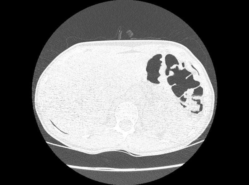 File:Bronchogenic cyst (Radiopaedia 80273-93615 Axial lung window 55).jpg