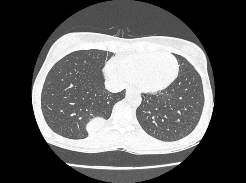 File:Bronchogenic cyst (Radiopaedia 80273-93615 Axial lung window 9).jpg