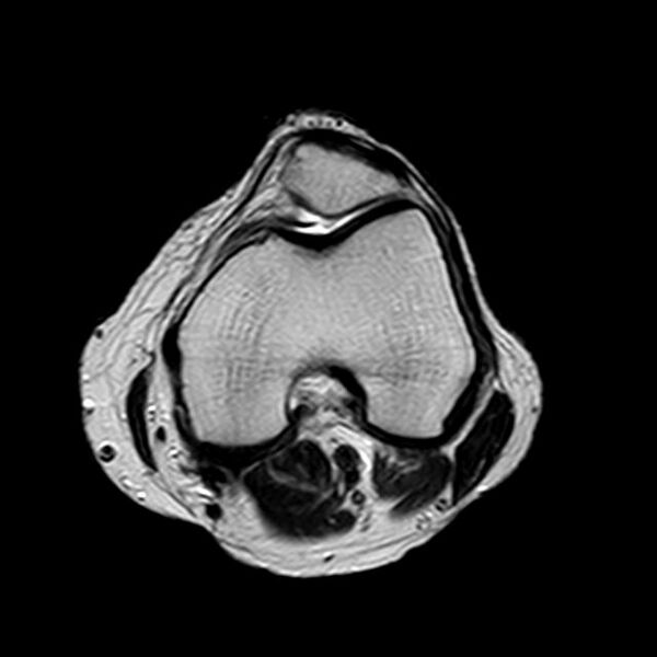 File:Bucket handle tear - medial meniscus (Radiopaedia 29250-29664 Axial T2 11).jpg