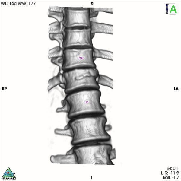 File:Bulging of paraspinal line in traumatic thoracal spinal compression fracture (Radiopaedia 29221-35872 3D VR 9).jpg