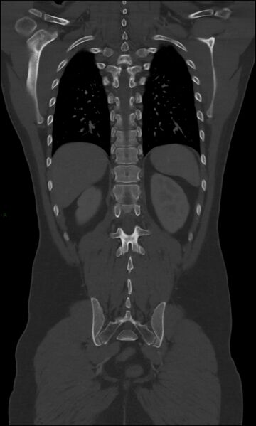 File:Burst fracture (Radiopaedia 83168-97542 Coronal bone window 55).jpg
