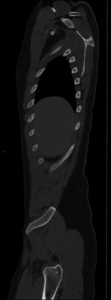 File:Burst fracture (Radiopaedia 83168-97542 Sagittal bone window 29).jpg