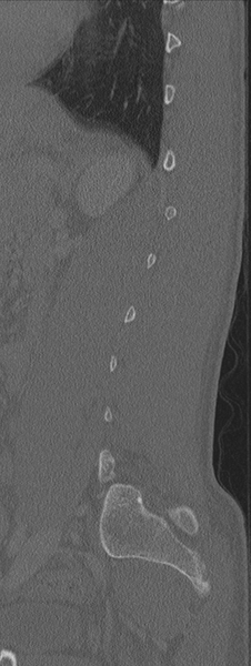 File:Burst fracture - T12 with conus compression (Radiopaedia 56825-63647 Sagittal bone window 20).png