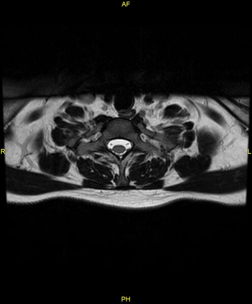 File:C5 nerve sheath tumor (Radiopaedia 85777-101596 Axial T2 72).jpg