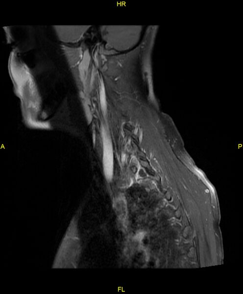 File:C5 nerve sheath tumor (Radiopaedia 85777-101596 F 5).jpg
