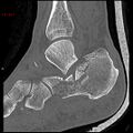 Calcaneal fracture and associated spinal injury (Radiopaedia 17896-17656 Sagittal bone window 4).jpg