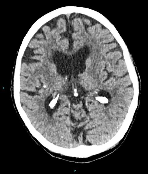 File:Calcified cerebral emboli from left ventricular thrombus (Radiopaedia 84420-99758 Axial non-contrast 47).jpg