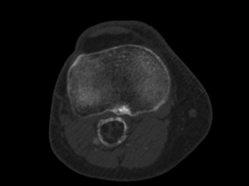 File:Calcified hematoma - popliteal fossa (Radiopaedia 63938-72763 C 42).jpg