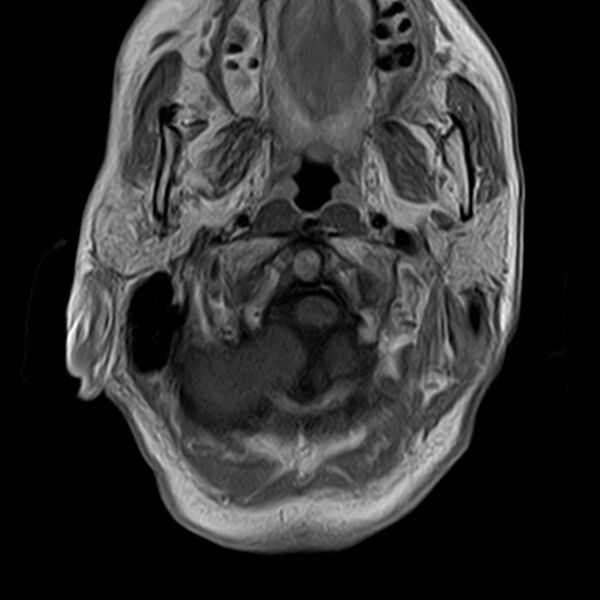 File:Calcified meningioma - cervical canal (Radiopaedia 70136-82468 Axial T1 C+ 6).jpg