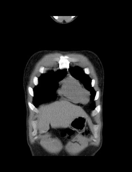 File:Calcifying pulmonary metastases (Radiopaedia 33359-34396 Coronal non-contrast 43).jpg