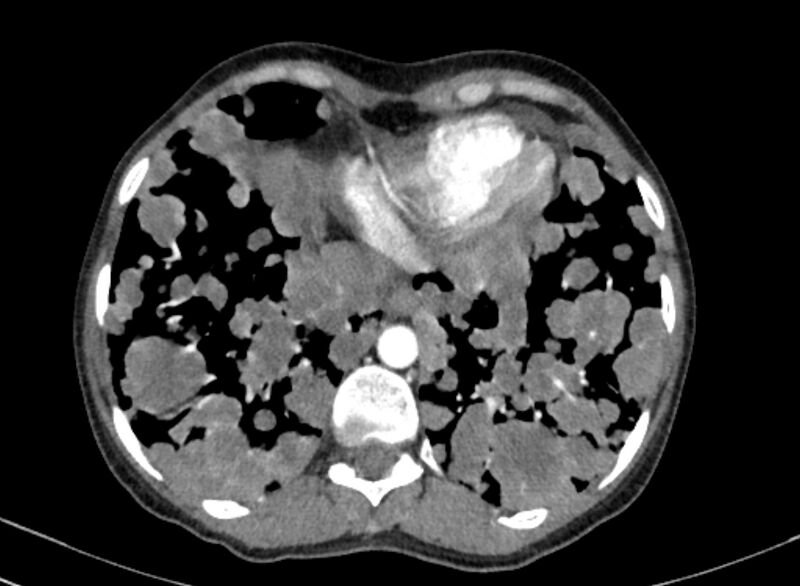 File:Cannonball metastases from breast cancer (Radiopaedia 91024-108569 A 95).jpg