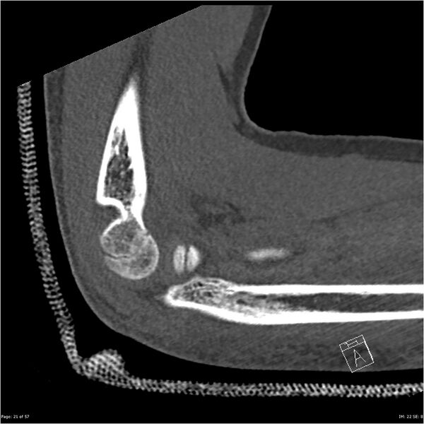 File:Capitellum fracture (Radiopaedia 23352-23426 Sagittal bone window 21).jpg