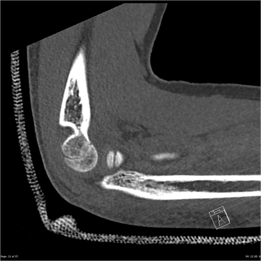 Capitellum fracture (Radiopaedia 23352-23426 Sagittal bone window 21).jpg