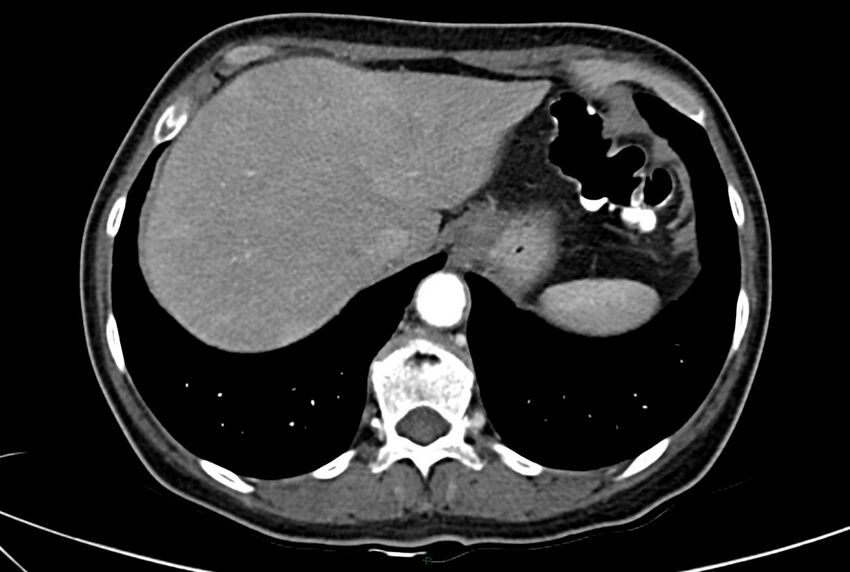 Carcinoid mesenteric tumor complicated by chylous ascites (Radiopaedia 76312-88926 A 10).jpg
