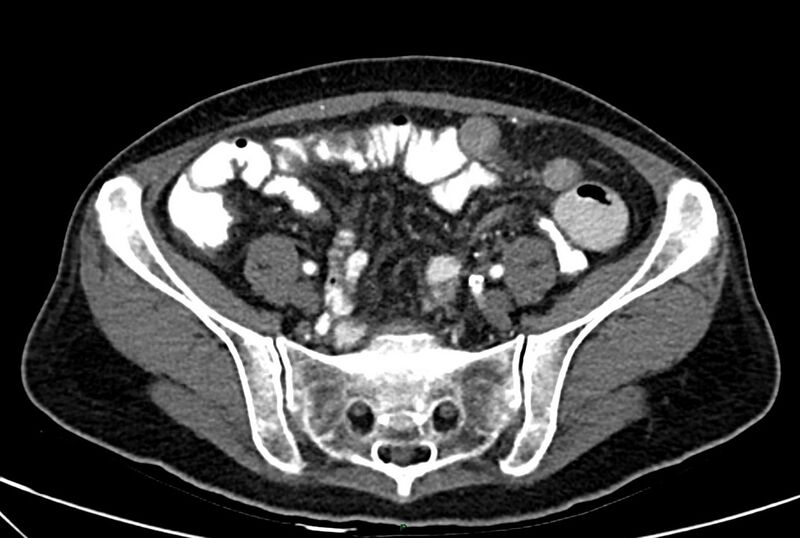 File:Carcinoid mesenteric tumor complicated by chylous ascites (Radiopaedia 76312-88926 A 54).jpg